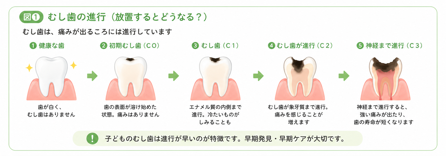 子どものむし歯の進行段階（健康な歯から神経まで進行する流れ）