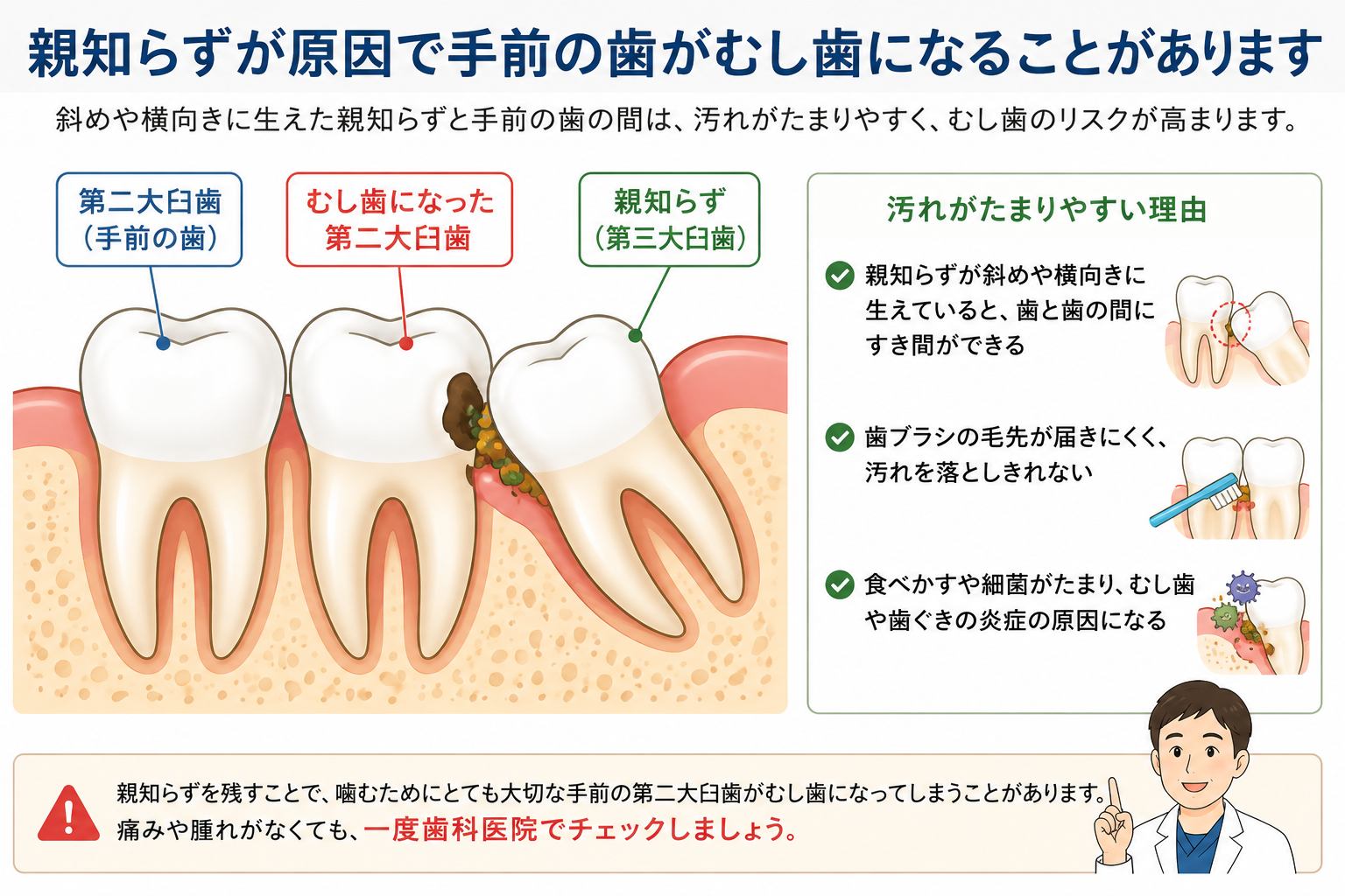 斜めに生えた親知らずが原因で手前の第二大臼歯がむし歯になる仕組み