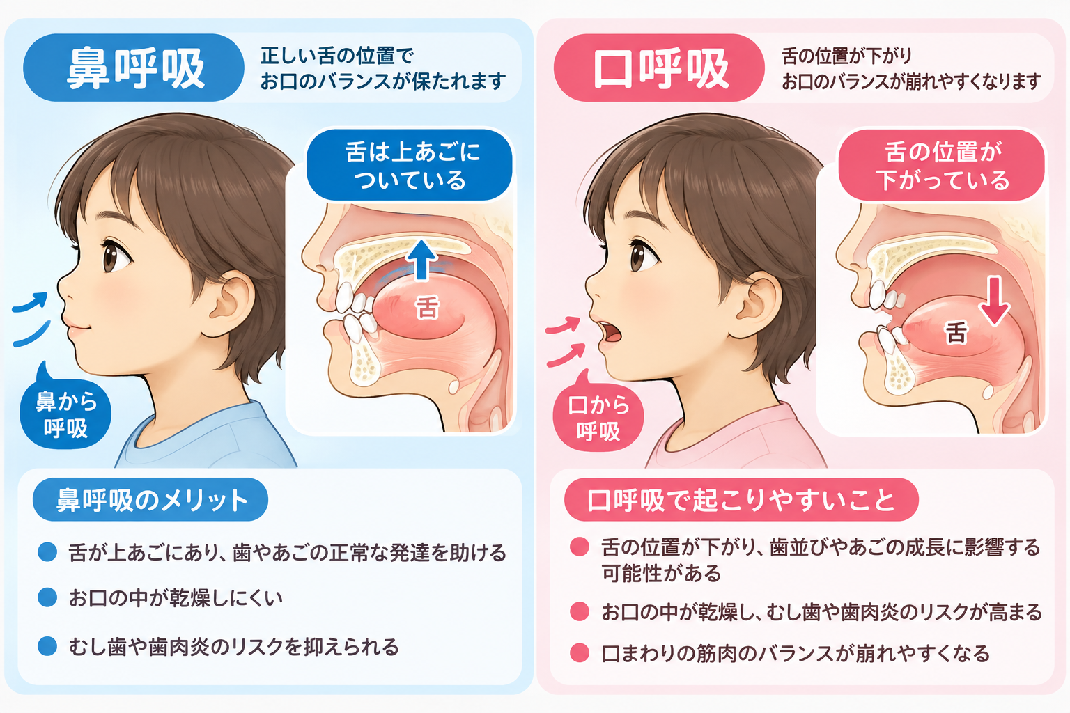 鼻呼吸と口呼吸による舌の位置の違いと歯並びへの影響を示すイラスト