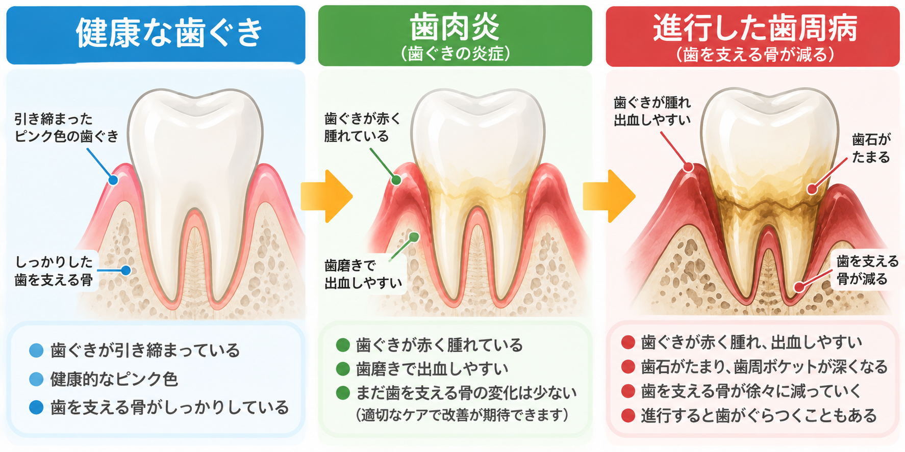 健康な歯ぐきから歯肉炎、進行した歯周病への変化を示すイラスト