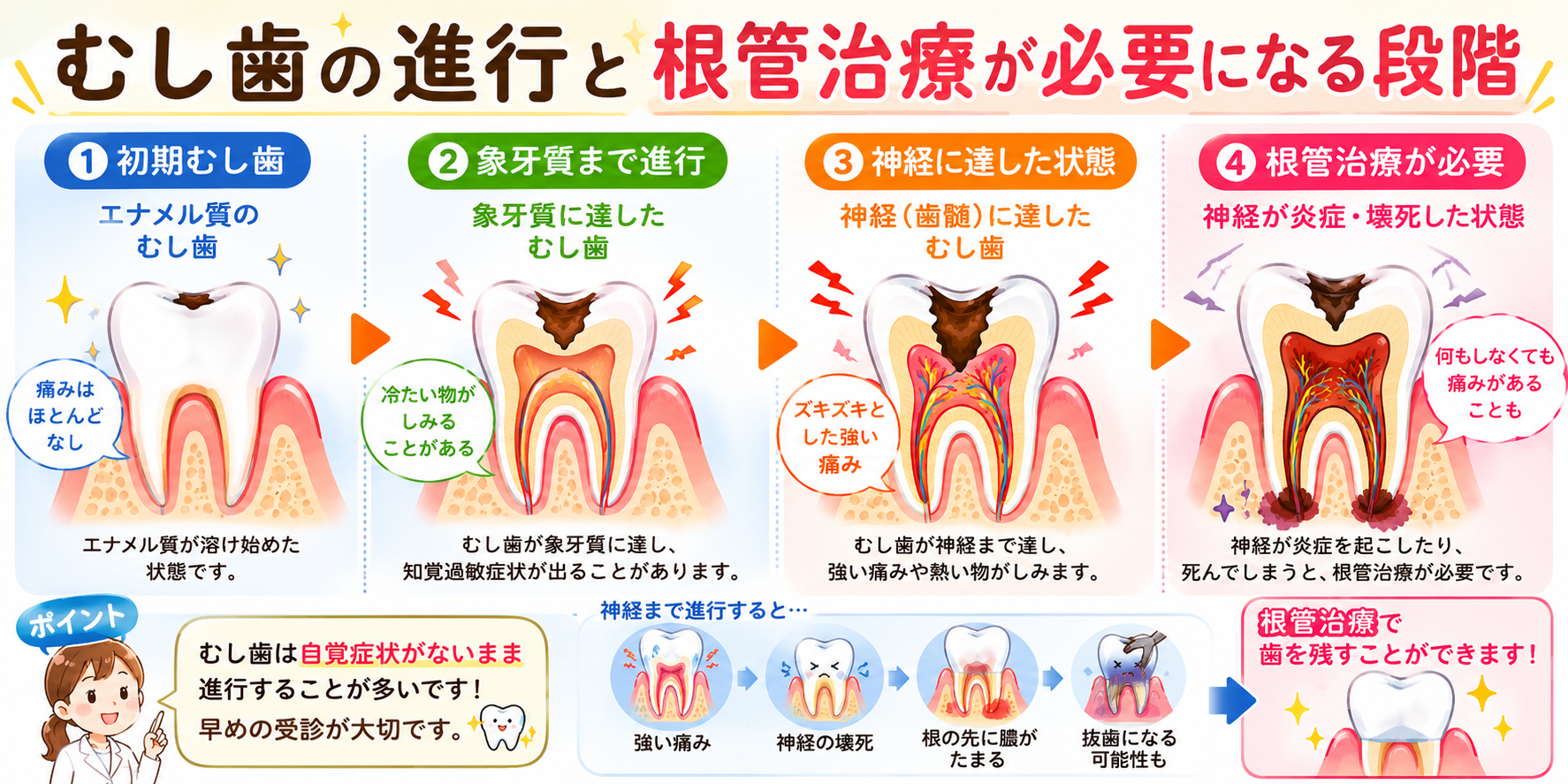 むし歯の進行と根管治療が必要になる段階を示したイラスト