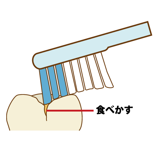 六歳臼歯の溝に汚れや細菌がたまりやすくむし歯になりやすい様子のイラスト