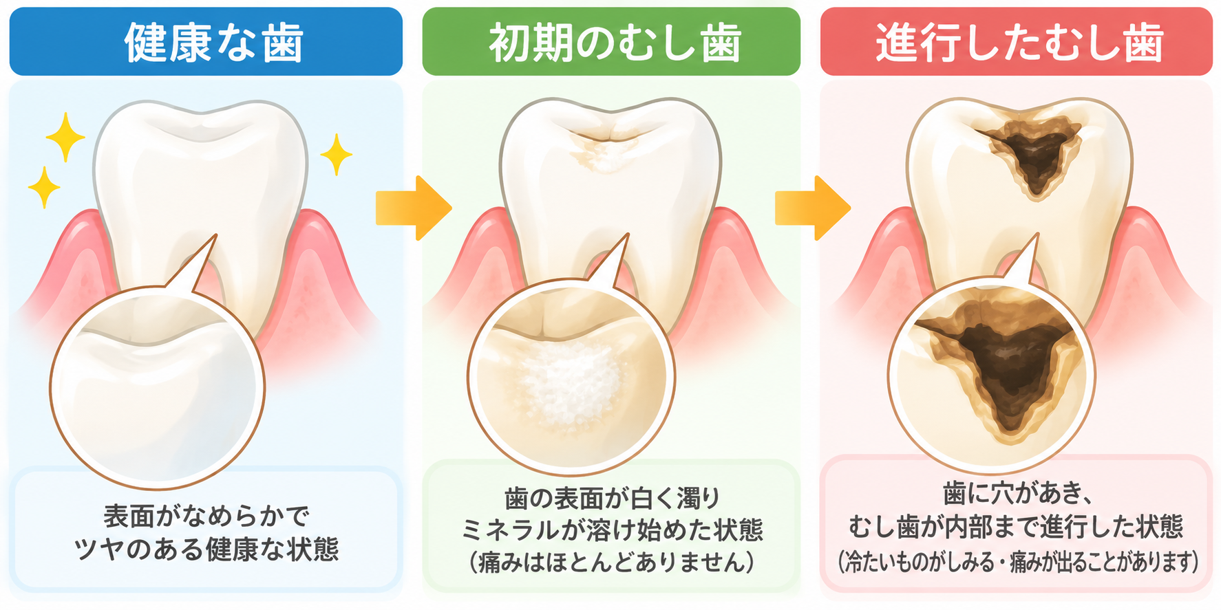 健康な歯から初期むし歯、進行したむし歯への変化を示すイラスト