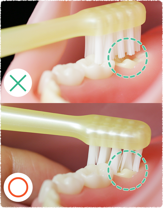 六歳臼歯への歯ブラシの入れ方を示した画像