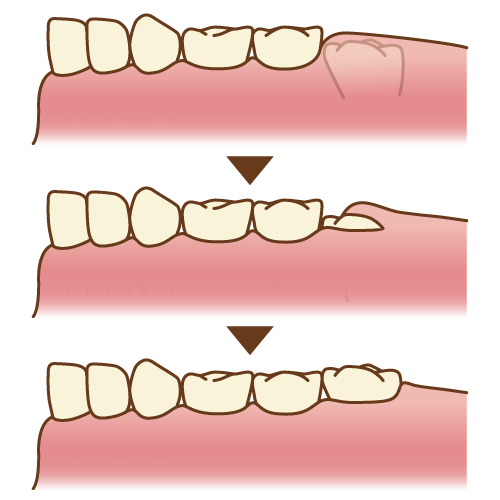 6歳頃に生える六歳臼歯の位置を示したイラスト