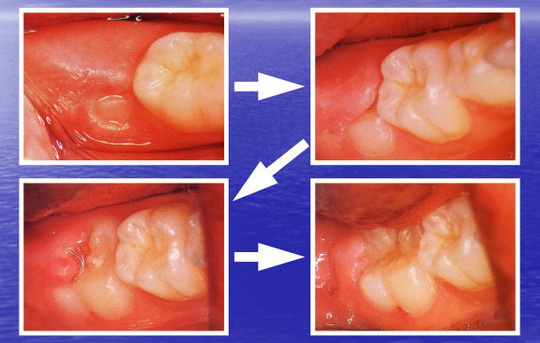 六歳臼歯が生えかけで歯ぐきに覆われ磨きにくい状態を示した写真